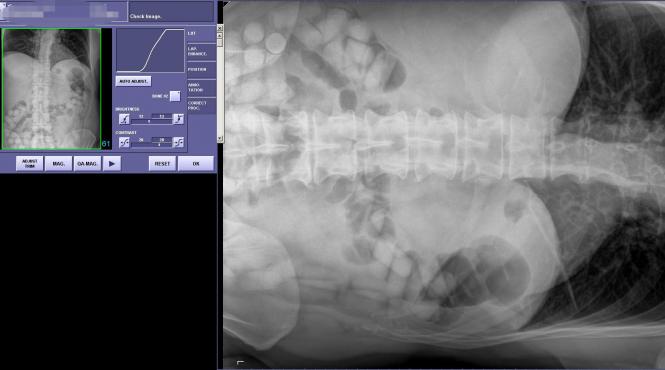 ascundea un kilogram de cocaina in stomac