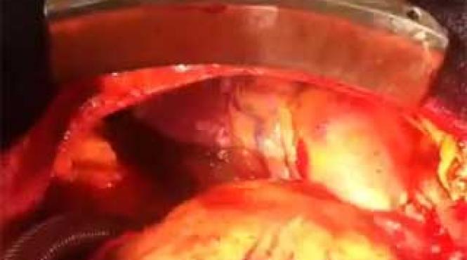 operatie medicala rara doua inimi bat in acelasi piept video