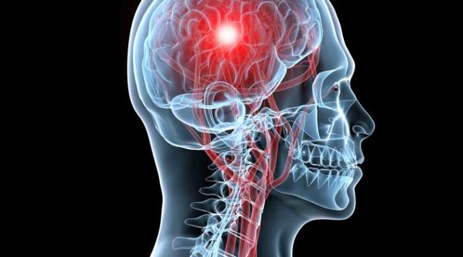 bila sau balon in vasele creierului