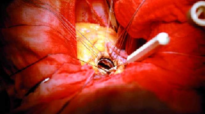 reparatii mai mari sau mai mici la inima