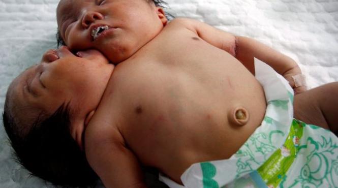 fetita cu doua capete nascuta in china