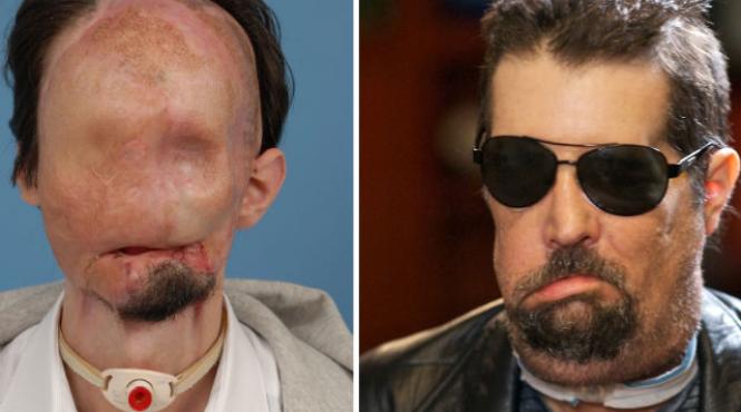 primul transplant total de fata din sua un succes