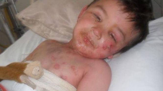 baietel de trei ani aproape ucis de o reactie alergica la nurofen
