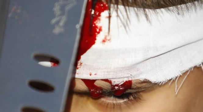 uimitor un adolescent a scapat teafar dupa ce o sabie i a intrat in cap 5 centimetri