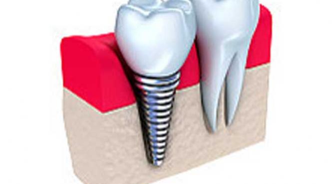 implantul dentar solutia cu manusi