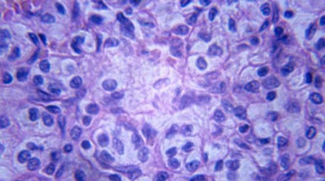 o simpla proteina ar putea bloca metastazele