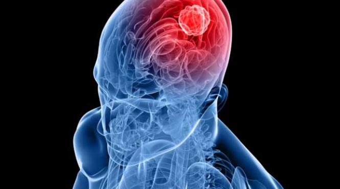 cancerul creierului si modificarile genetice