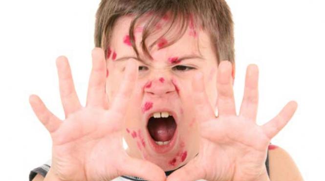 eruptiile febrile scarlatina rujeola rubeola eritemul infectios varicela meningococemia