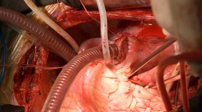 operata pe inima fara bisturiu