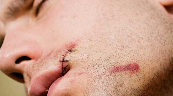 refacerea obrazului dupa cancerul gurii