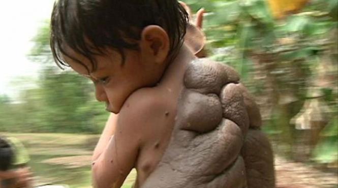 copilul testoasa a scapat de negul care ii acoperea spatele galerie foto