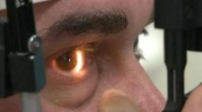 premiera medicala dupa 20 de ani de intuneric un barbat din marea britanie care a primit ochiul bionic vede din nou video