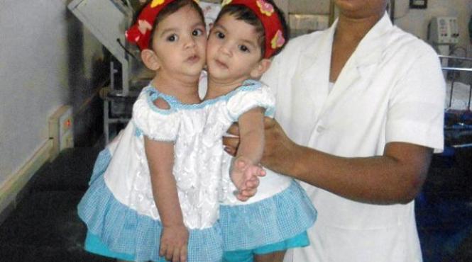 gemene siameze abandonate din cauza saraciei separate cu succes