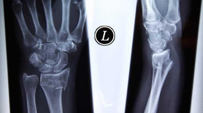 cat de mare este riscul de osteoporoza