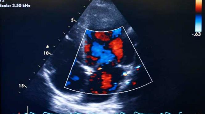 ce este histerosalpingografia