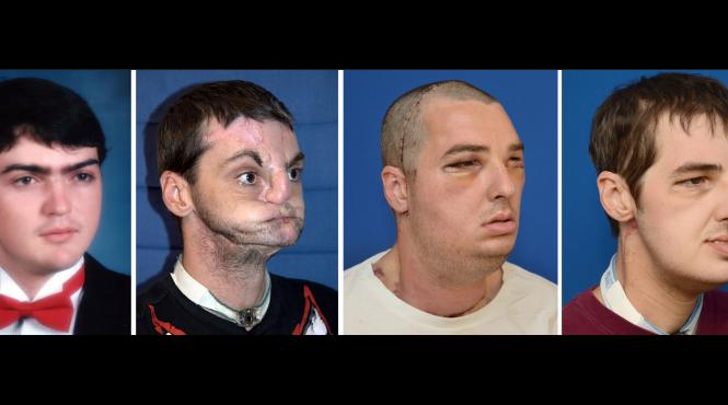 transplant de fata imagine