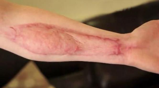 imagini socante la un pas de moarte dupa ce a fost muscata de un paianjen de casa aparent inofensiv