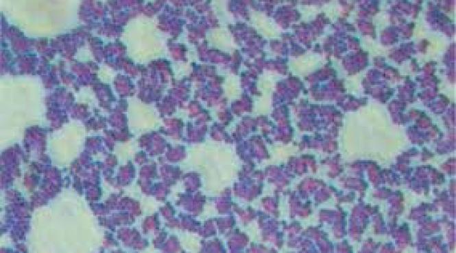 infectii plamani respiratorii