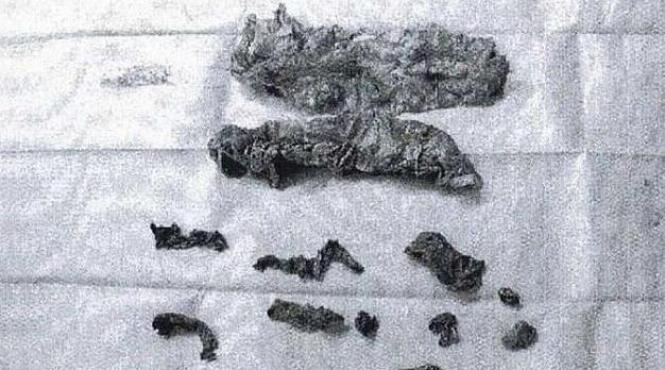 caz unic in medicina obiecte lasate de medici in corpul unui barbat in timpul operatiei