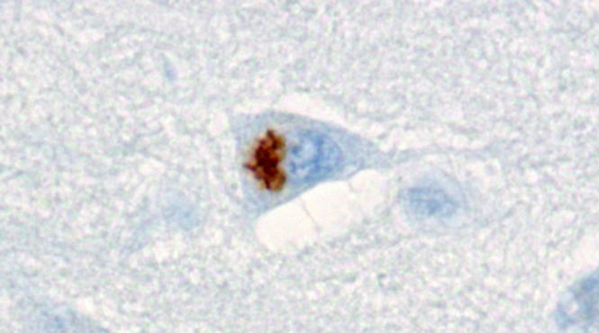 cauza dementei tratament