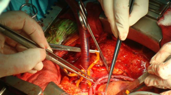 premiera in chirurgia cardiovasculara din romania la spitalul monza