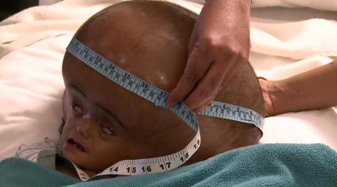 reusita extraordinara fetita cu cap de extraterestru operata cu succes cum arata acum video