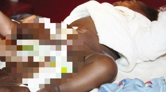 malformatia care i a socat pe medici un baietel s a nascut cu patru picioare doua fiind legate direct de stomac