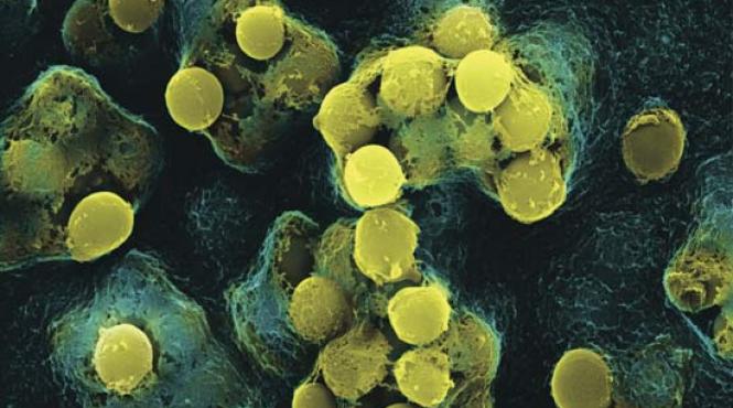 fasceita necrozanta grasime