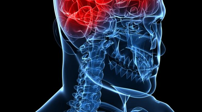 chiar tranzitoriu accidentul cerebral e periculos