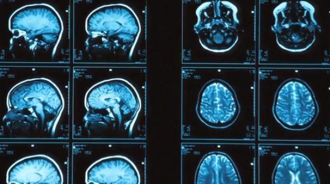 descoperire socanta ce a aflat un neurolog american dupa ce fara sa vrea si a studiat propriile rmn uri video