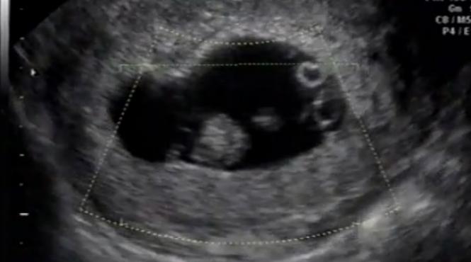 se intampla o data la 100 de milioane de nasteri ce a nascut o femeie din california a uluit medicii video