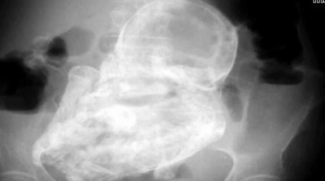 descoperire incredibila facuta de medicii din bogota ce au gasit specialistii in abdomenul unei femei de 82 de ani video