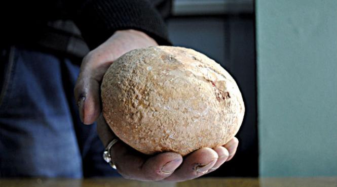 piatra la rinichi de aproape un kilogram scoasa dintr un pacient indian