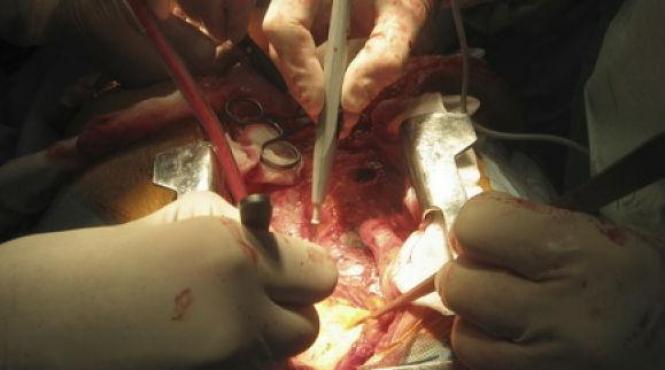 dupa 60 de zile de la implantarea bioprotezei barbatul cu inima artificiala e bine