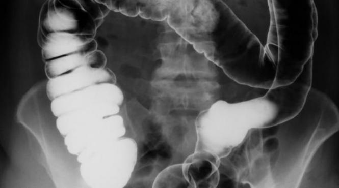 medicii din california in stare de soc ce au gasit specialistii in intestinul gros al unui barbat intrece orice imaginatie