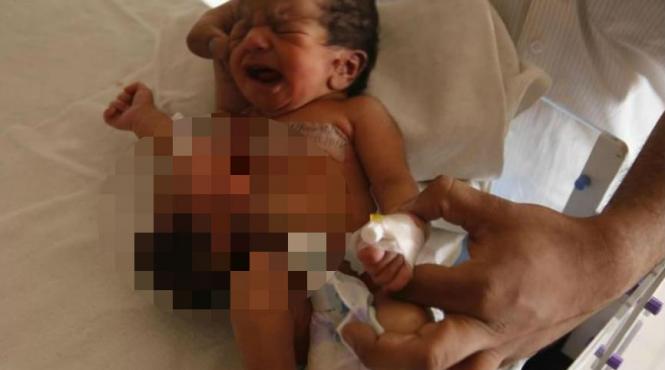 caz uluitor intr un spital din india o fetita s a nascut cu un al doilea cap atasat de stomac video