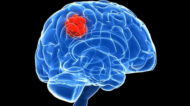 dr marian mitrica in ultimii ani a crescut cu 30 incidenta cancerelor cerebrale