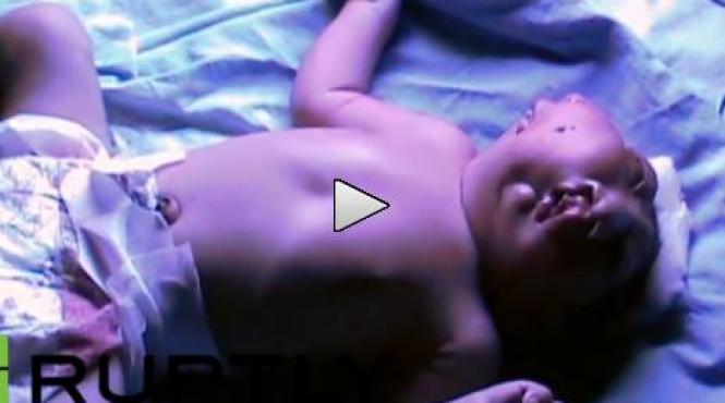 copil cu doua fete nascut in india doctorii sunt uluiti video