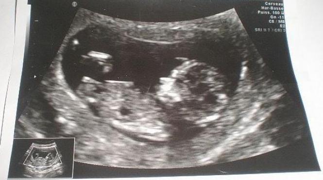 un caz la 200 de milioane adevarat soc ce a nascut o tanara de 20 de ani