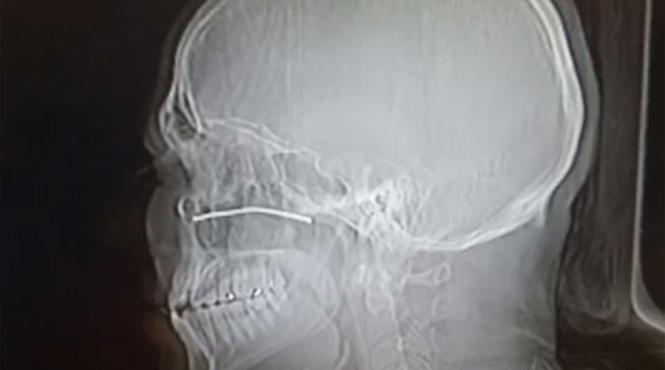 un barbat a supravietuit dupa ce o bucata de metal i a intrat in cap