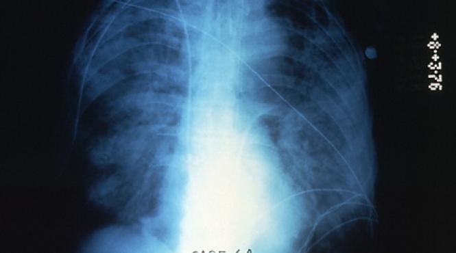 legioneloza boala care face ravagii la new york sapte oameni au murit deja