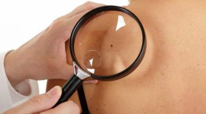 cancer crestere ingrijoratoare a numarului de bolnavi in botosani