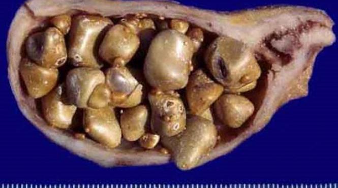 cea mai eficienta metoda de eliminare a pietrelor de la bila solutia este 100 naturala