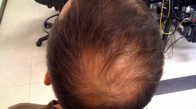 savantii americani au descoperit un tratament revolutionar pentru calvitie