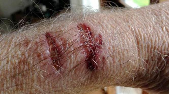 ceasul apple poate provoca arsuri posesorului