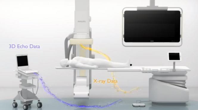 video premiera in europa copii operati pe cord inchis in franta gratie unei tehnologii 3d