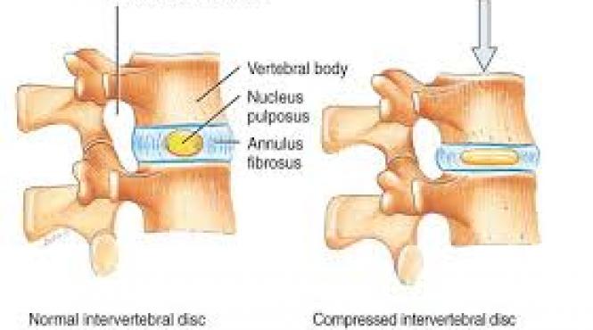 vesti bune pentru cei care sufera de hernie de disc au fost create celule susa pentru repararea discurilor intervertebrale