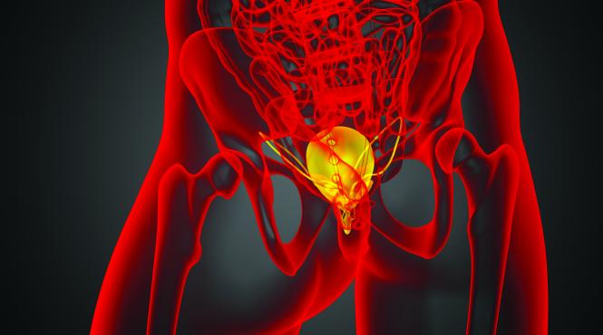 acul de aur radioactiv din prostata