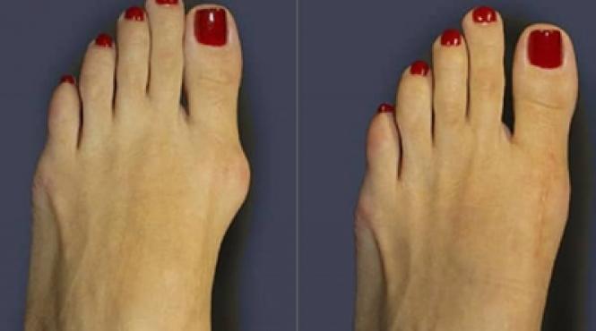 solutii alternative pentru a scapa de durerile provocate de monturi