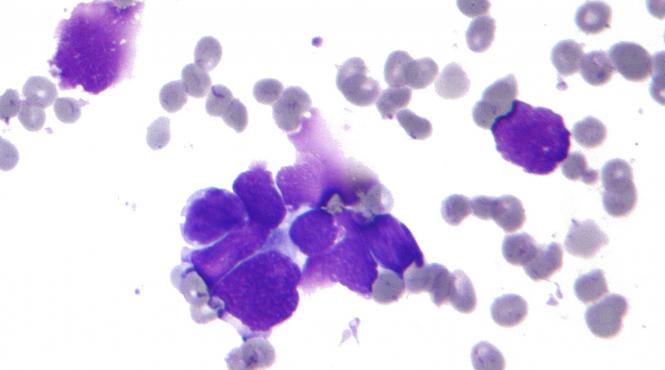 stresul cronic un factor important al raspandirii cancerului